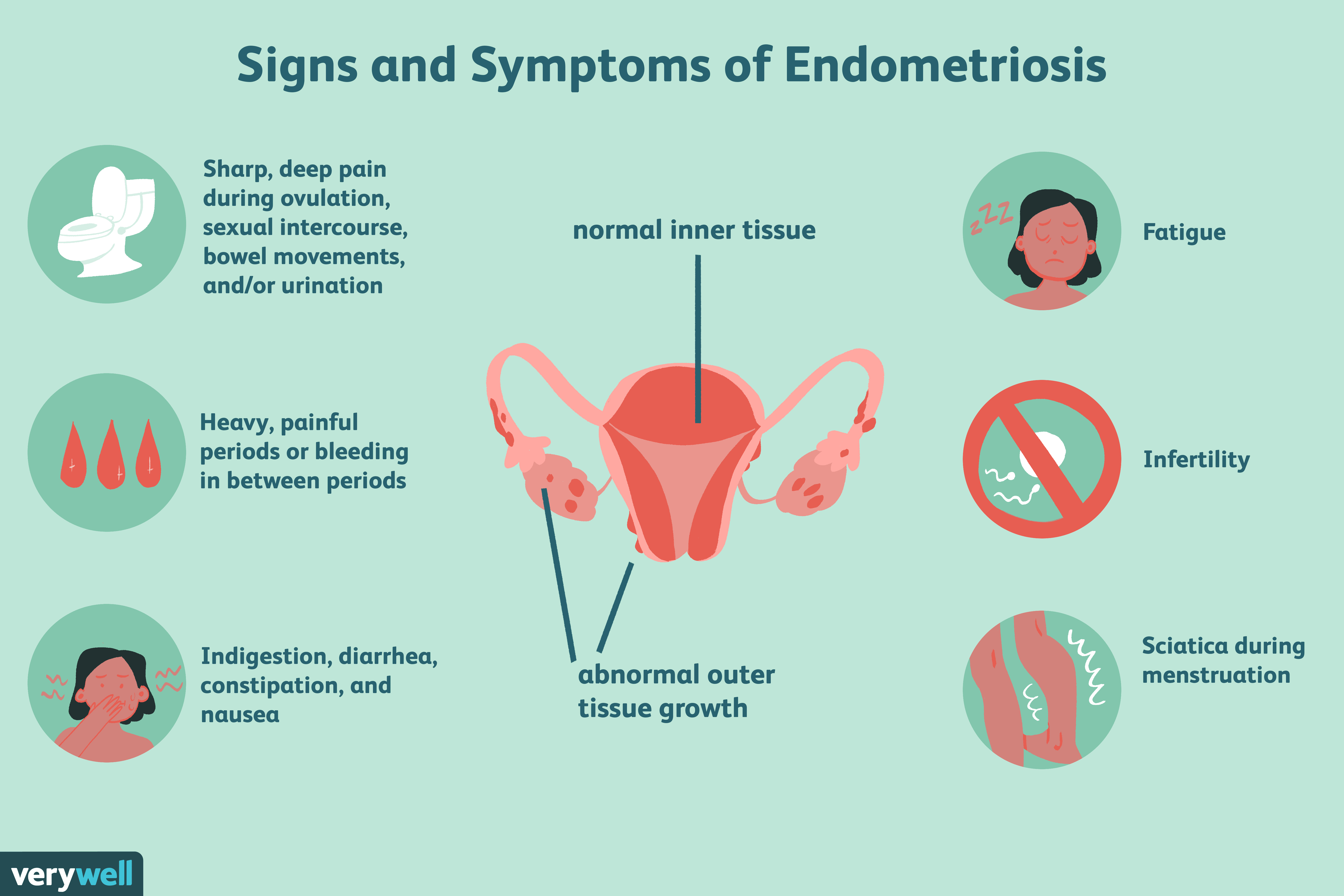 What you need to know about endometriosis treatment with plant based therapy 36586 1 - What you need to know about endometriosis treatment with plant-based therapy