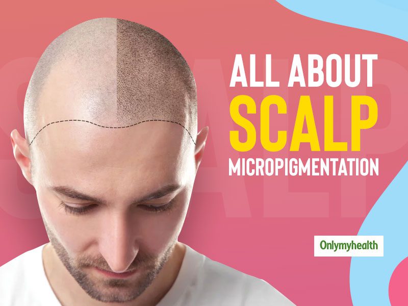Why Scalp Micropigmentation is the Hot New Trend in Hair Loss Treatments 178618 1 - Why Scalp Micropigmentation is the Hot New Trend in Hair Loss Treatments